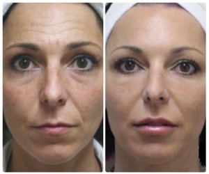 Exemple d'un visage féminin avant et après une injection de botox