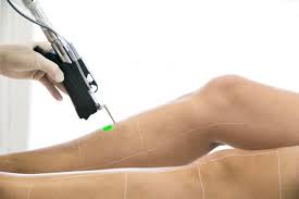 épilation laser des jambes